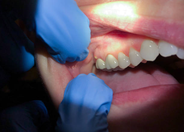 Best Emergency Treatment for Dental Infections or Abscesses in Point Pleasant, WV